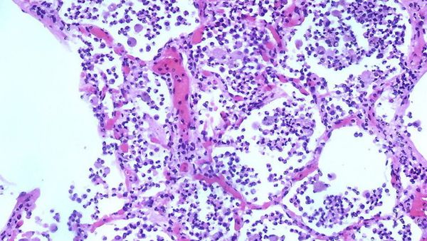 Microscopic image of acute pneumonia - Sputnik International