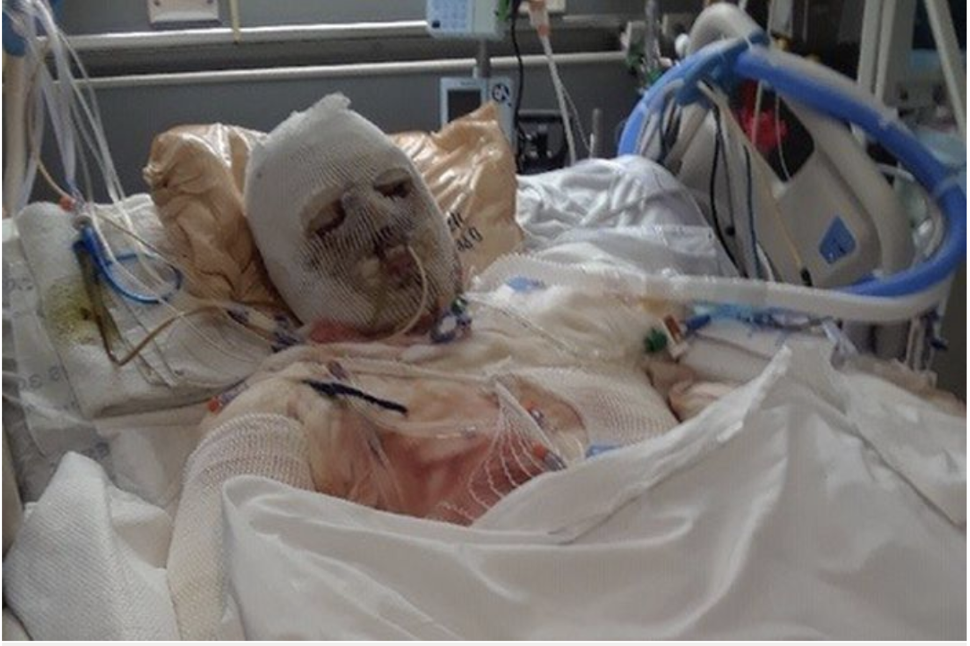 Photos: US Man Has ‘New Chance at Life’ After Receiving First Successful Face, Hands Transplant Photos: US Man Has ‘New Chance at Life’ After Receiving First Successful Face, Hands Transplant - Sputnik International, 1920, 03.02.2021