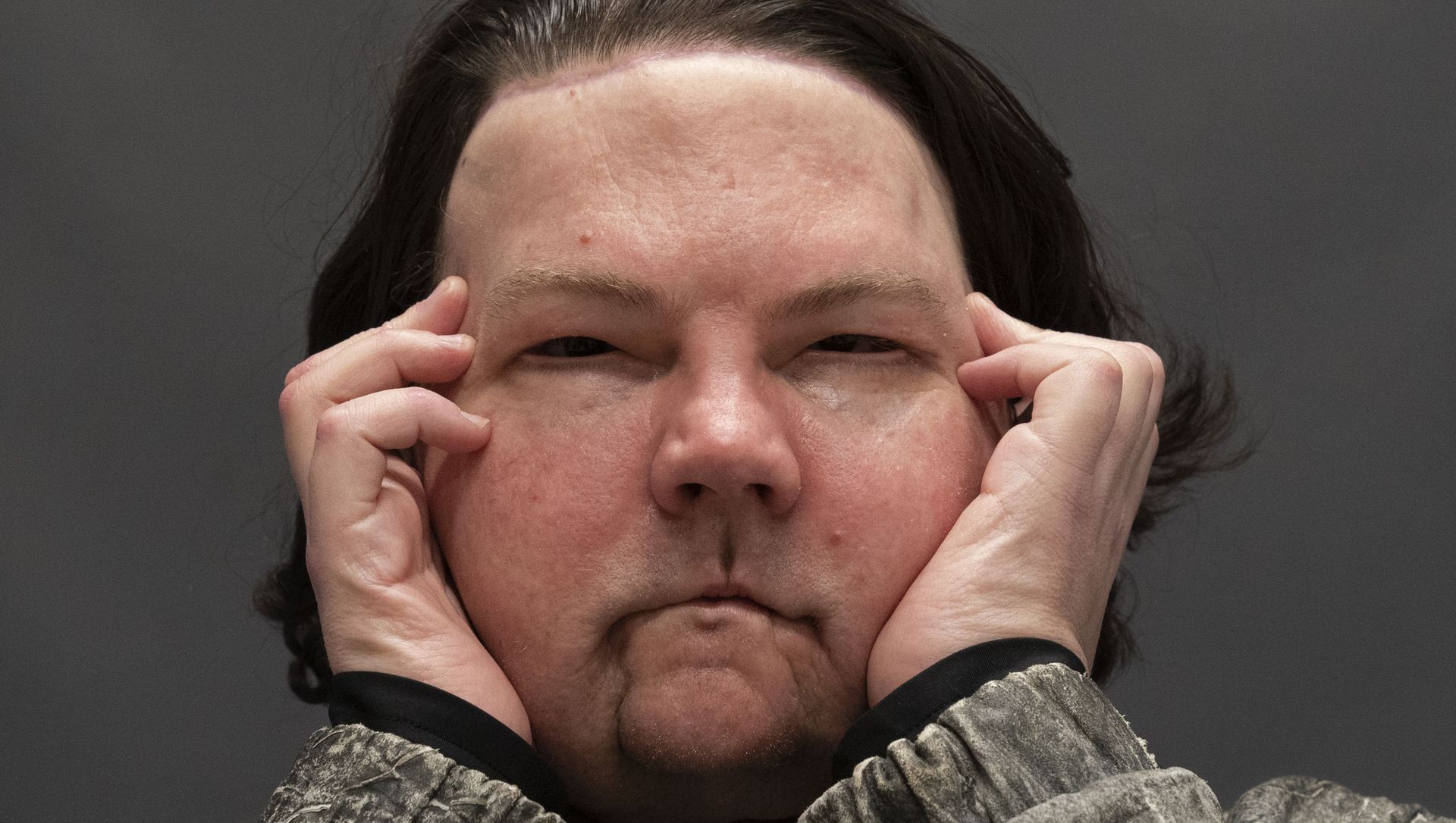 Joe DiMeo poses for a portrait, Monday, Jan. 25, 2021 at NYU Langone Health in New York, six months after an extremely rare double hand and face transplant. Joe DiMeo poses for a portrait, Monday, Jan. 25, 2021 at NYU Langone Health in New York, six months after an extremely rare double hand and face transplant. - Sputnik International, 1920, 03.02.2021