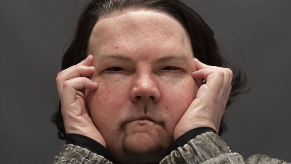 Joe DiMeo poses for a portrait, Monday, Jan. 25, 2021 at NYU Langone Health in New York, six months after an extremely rare double hand and face transplant. - Sputnik International