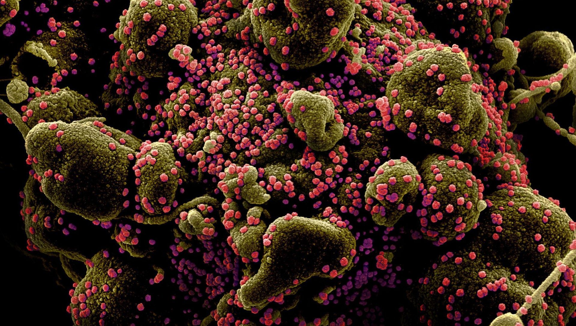 Colorized scanning electron micrograph of an apoptotic cell (greenish brown) heavily infected with SARS-COV-2 virus particles (pink), also known as novel coronavirus, isolated from a patient sample. Image captured and color-enhanced at the NIAID Integrated Research Facility (IRF) in Fort Detrick, Maryland. Colorized scanning electron micrograph of an apoptotic cell (greenish brown) heavily infected with SARS-COV-2 virus particles (pink), also known as novel coronavirus, isolated from a patient sample. Image captured and color-enhanced at the NIAID Integrated Research Facility (IRF) in Fort Detrick, Maryland. - Sputnik International, 1920, 15.02.2021