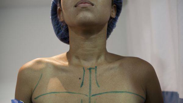Breast   surgery - Sputnik International