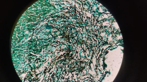 Section shows candidial hyphae and yeast forms (White Fungus) - Sputnik International