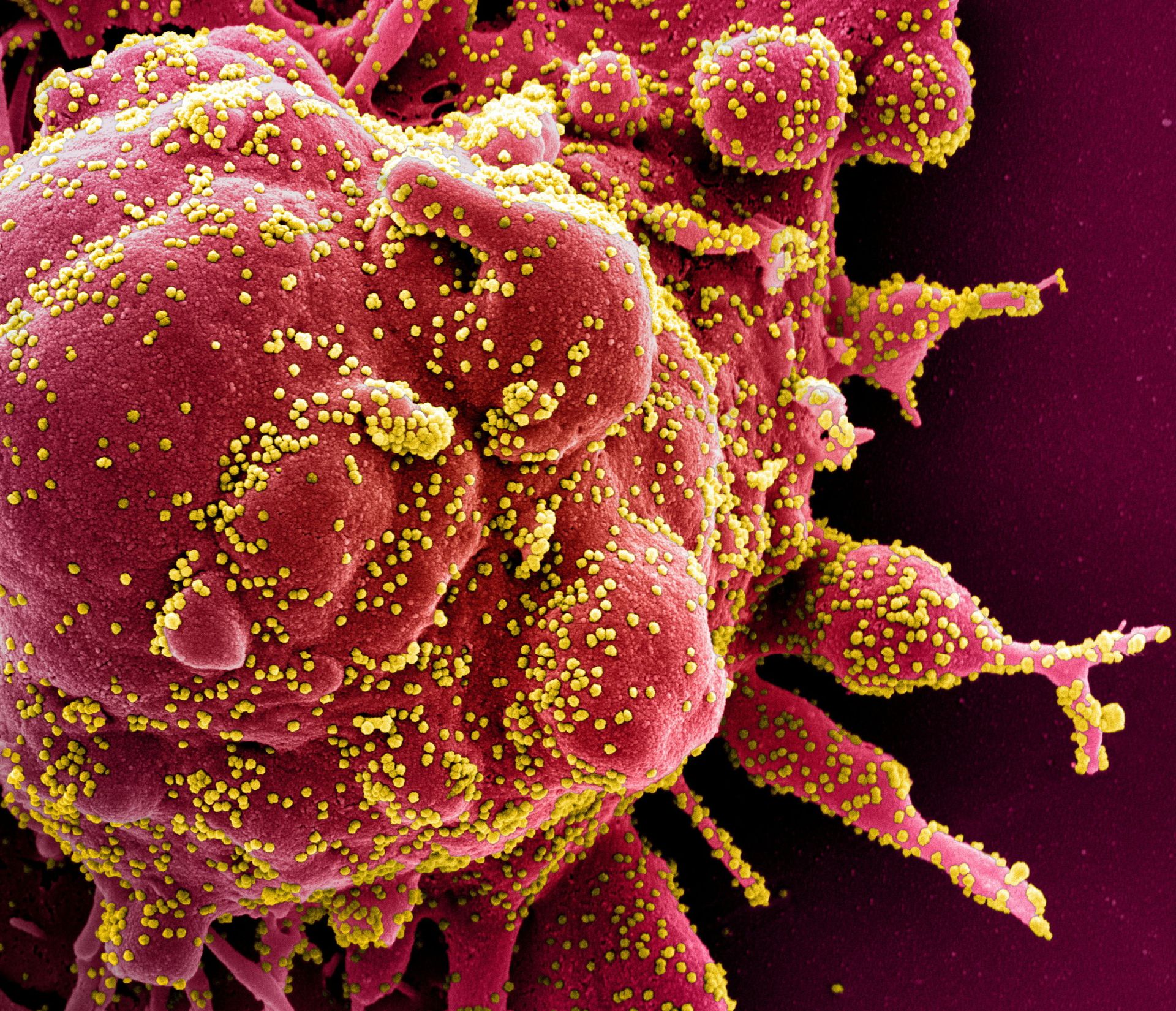 Colorized scanning electron micrograph of an apoptotic cell (red) infected with SARS-COV-2 virus particles (yellow), also known as novel coronavirus, isolated from a patient sample. Image captured at the NIAID Integrated Research Facility (IRF) in Fort Detrick, Maryland - Sputnik International, 1920, 07.09.2021