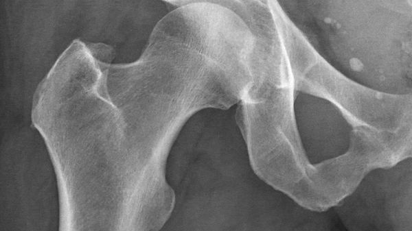 X-ray of the hip  - Sputnik International