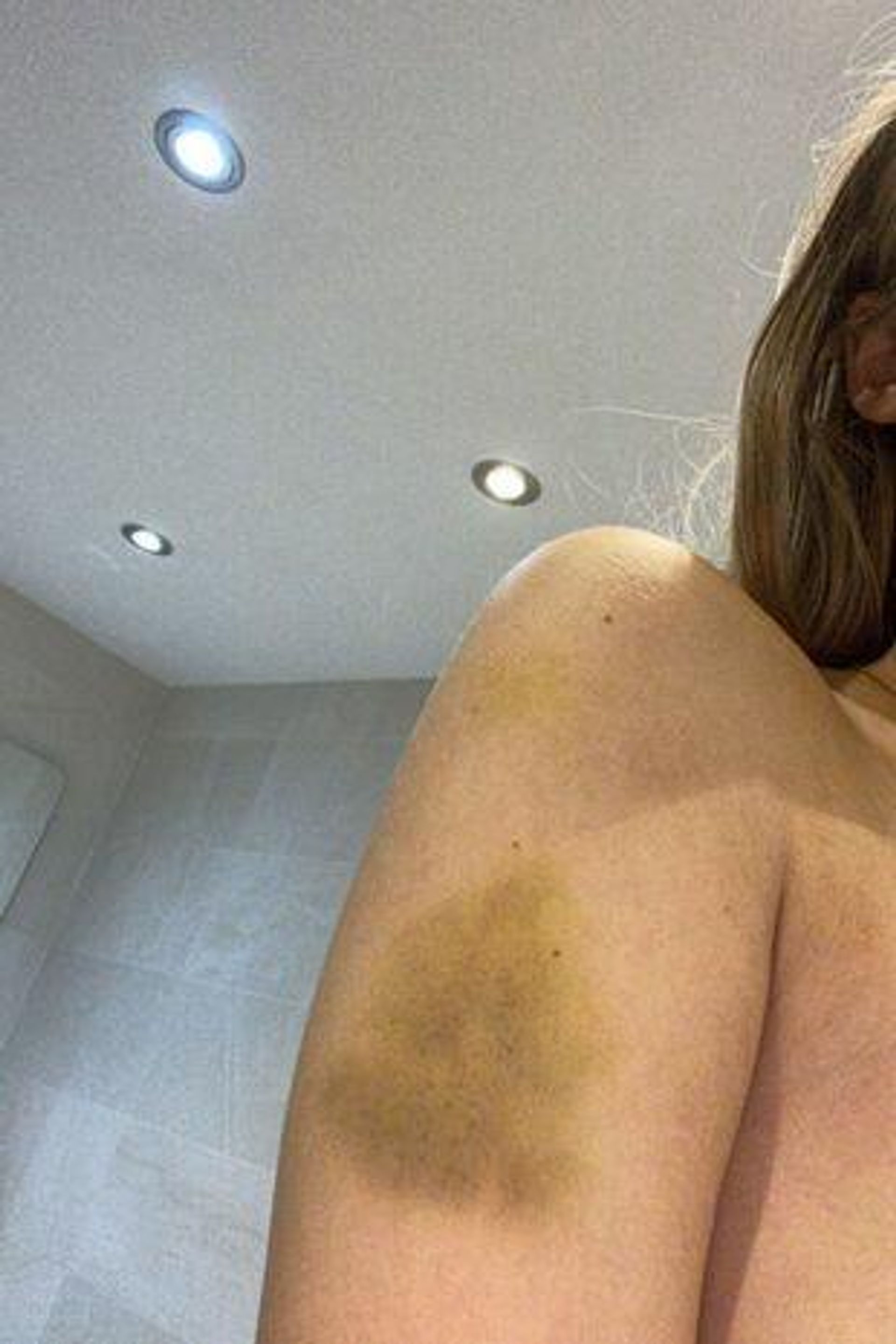 Screenshot of a deleted post published by Harriet Robson, depicting a bruise as she accuses her boyfriend Mason Greenwood of abuse. - Sputnik International, 1920, 30.01.2022