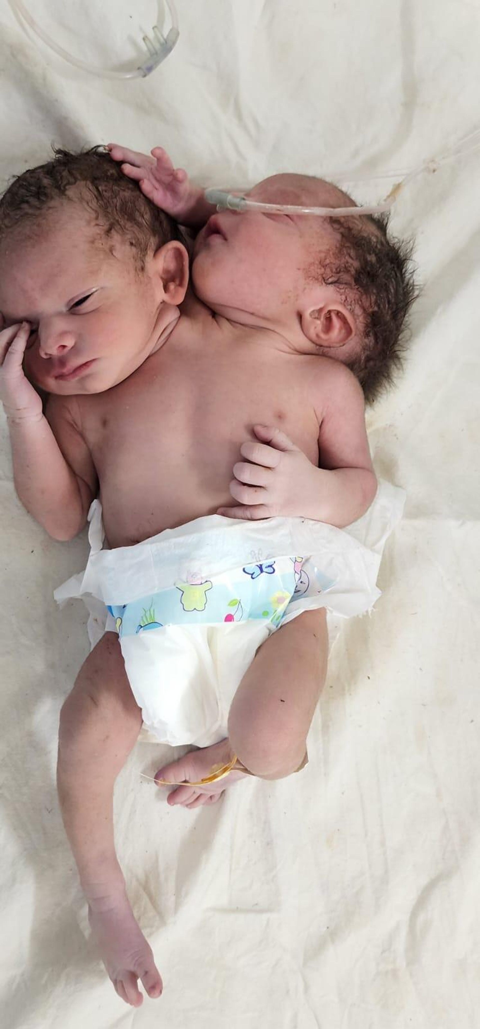 Picture of a baby born with two heads, three hands in India's Madhya Pradesh state's Ratlam district - Sputnik International, 1920, 30.03.2022