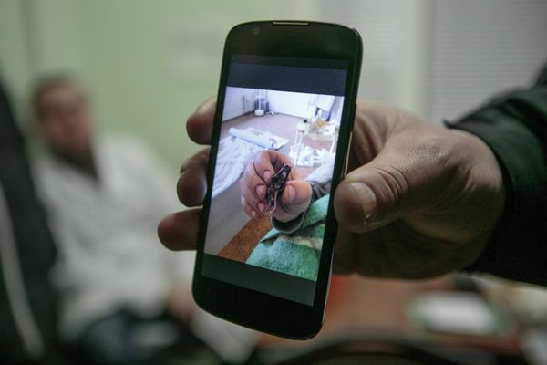 Doctor from the Donetsk Military Hospital #1 shows a photo of shrapnel removed from the body of a wounded soldier. - Sputnik International
