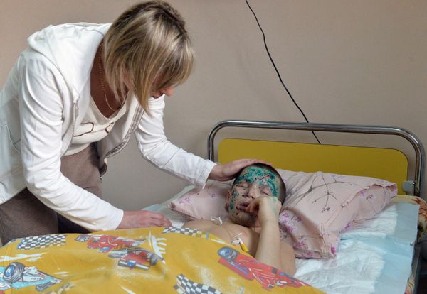 Nine-year-old Vanya Voronov was seriously injured when a shell exploded in Shakhtyorsk, Donetsk region. The boy lost his eyesight, both legs, and an arm. He was transported to Moscow for treatment in 2015. Vanya's younger brother Timofey was killed. - Sputnik International