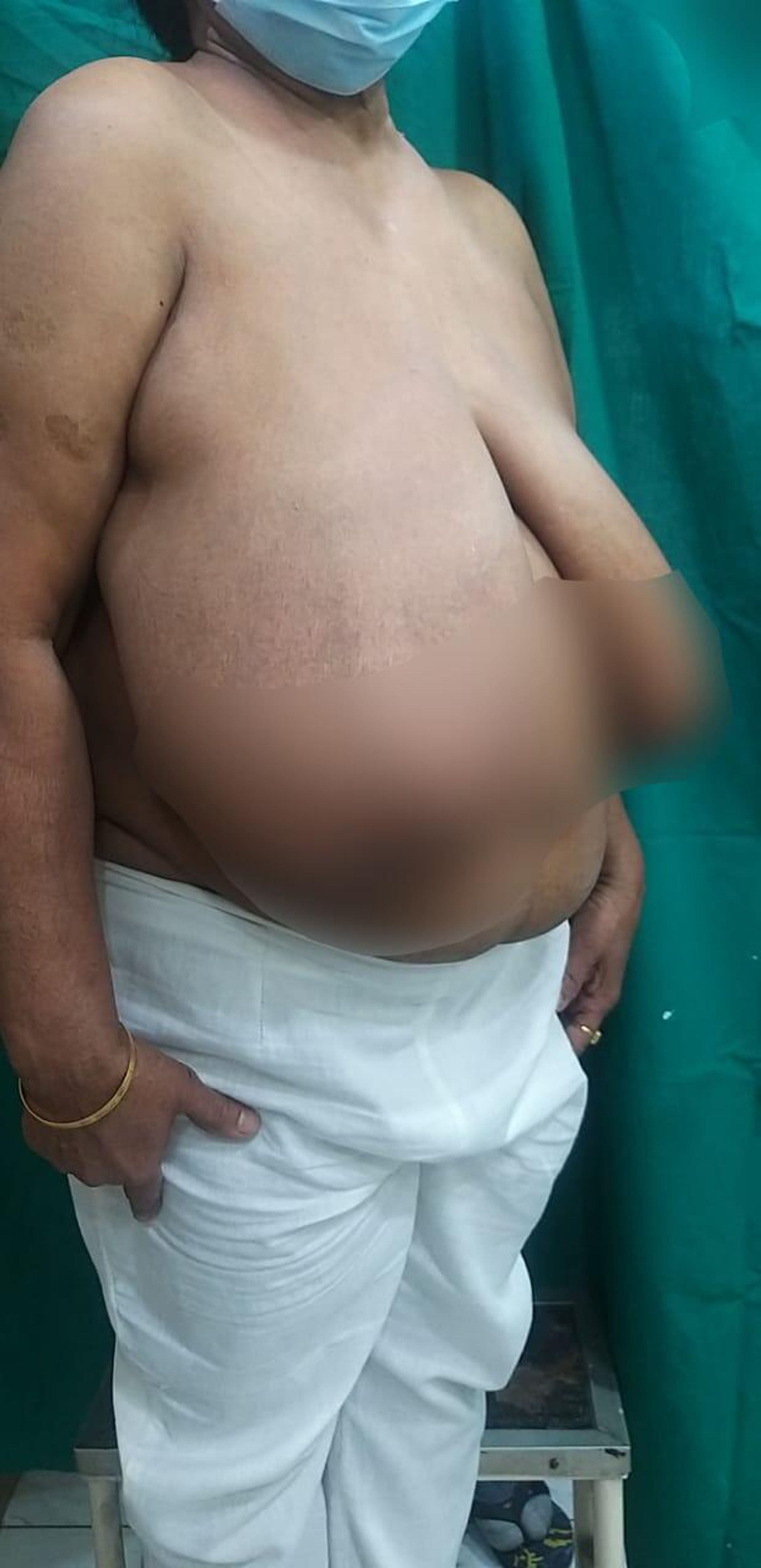 Patient with gigantomastia - Sputnik International, 1920, 27.04.2022