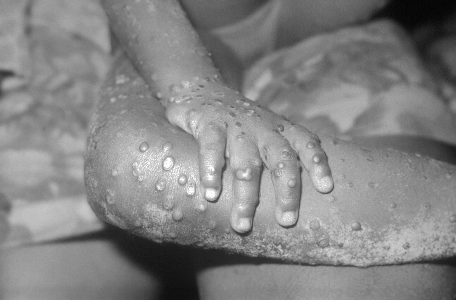This image from 1971, depicts a view of the right hand and leg, of a 4 year-old female in Bondua, Grand Gedeh County, Liberia, which reveals numerous maculopapular monkeypox lesions, enabling you to see the similarity of these lesions to those of smallpox. This image from 1971, depicts a view of the right hand and leg, of a 4 year-old female in Bondua, Grand Gedeh County, Liberia, which reveals numerous maculopapular monkeypox lesions, enabling you to see the similarity of these lesions to those of smallpox. - Sputnik International, 1920, 18.05.2022