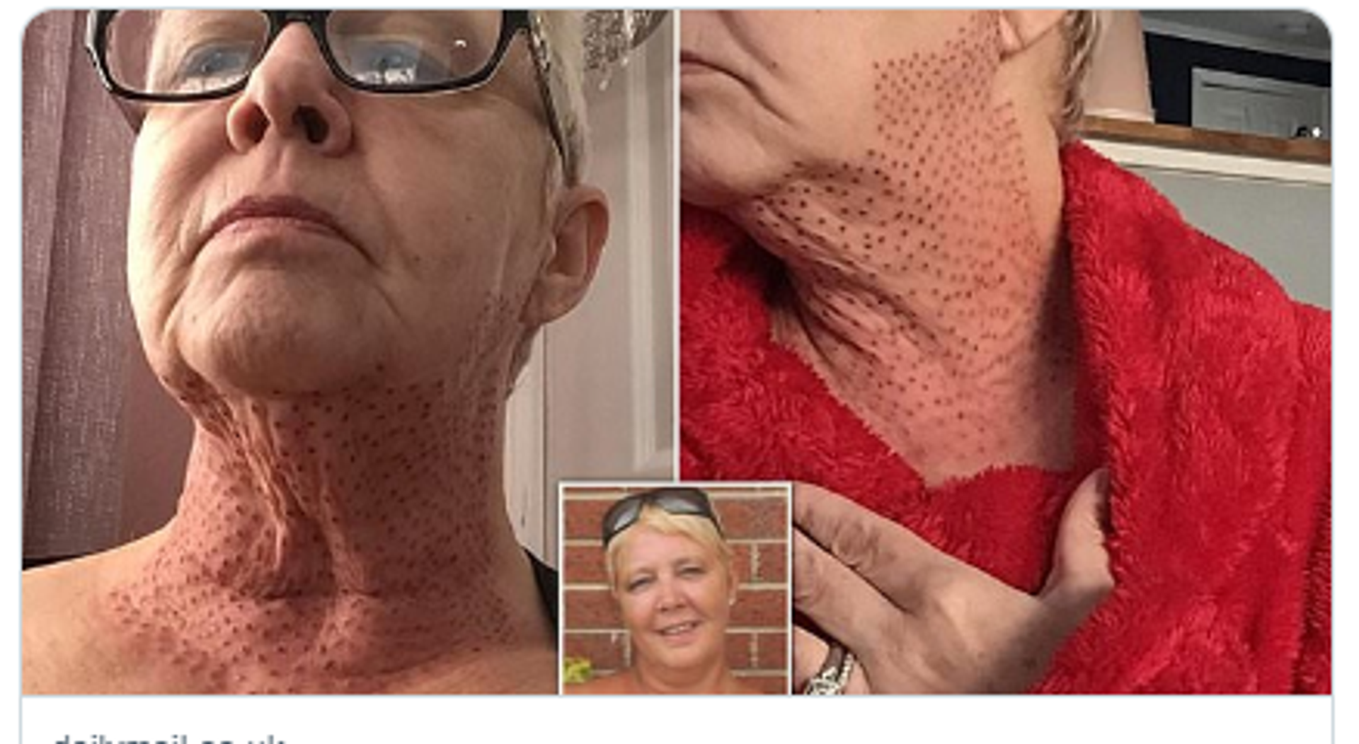 Woman in UK Left With ‘Lizard Neck’ After Skin-Tightening Procedure Goes Wrong -- Photo - Sputnik International, 1920, 10.08.2022
