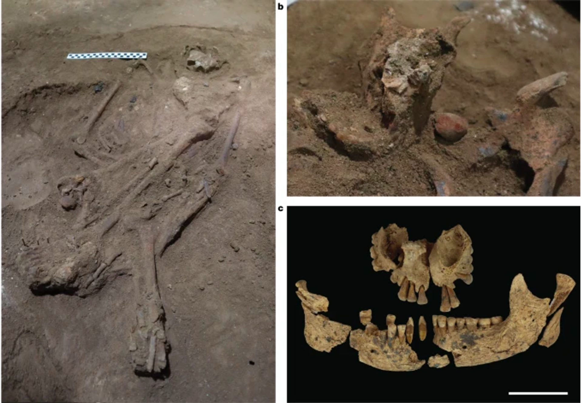 Surgical amputation of a limb 31,000 years ago in Borneo - Sputnik International, 1920, 08.09.2022