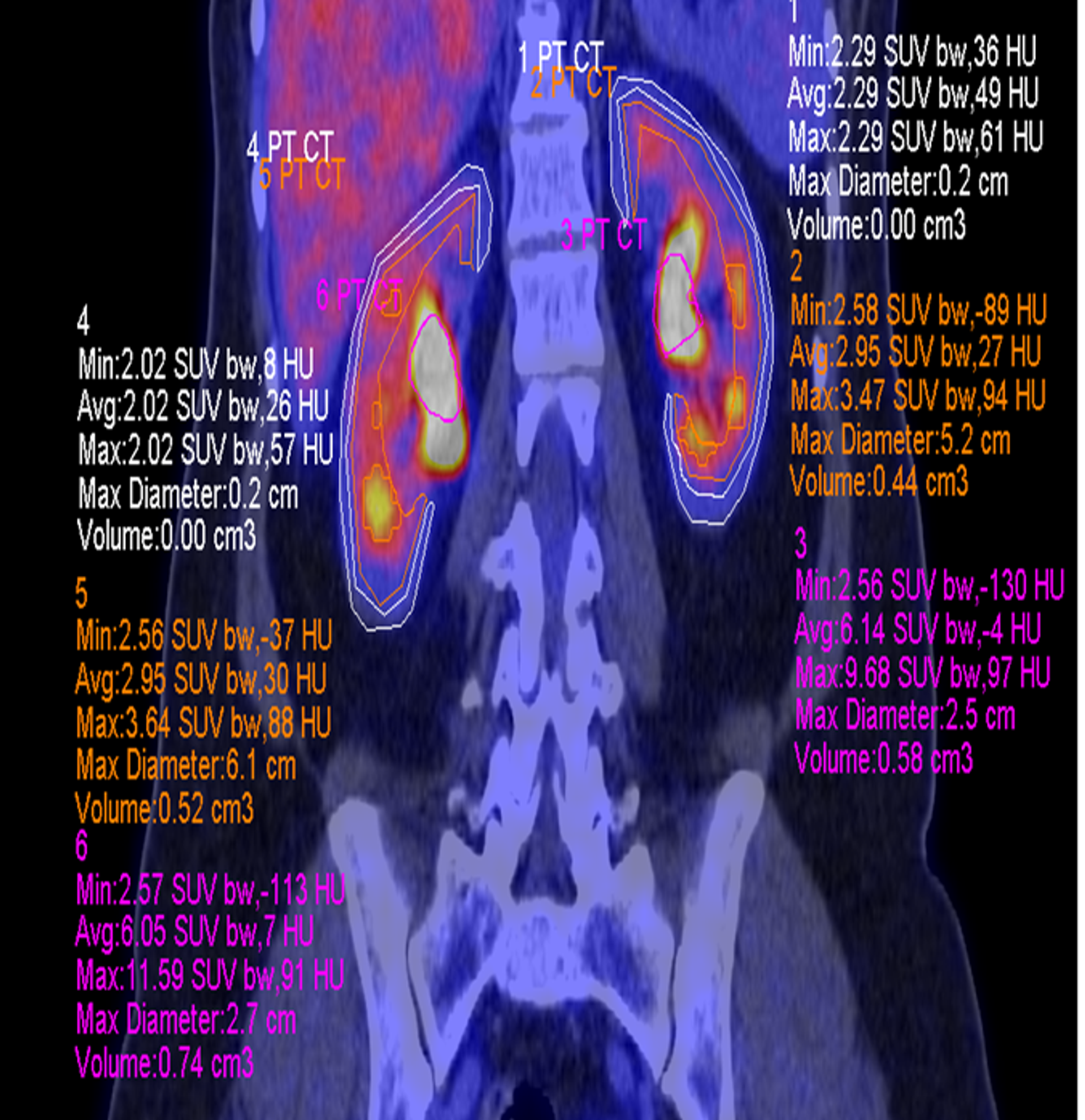 Reduced metabolism in both kidneys - stage close to stunning. Clinical and laboratory manifestations still absent Reduced metabolism in both kidneys - stage close to stunning. Clinical and laboratory manifestations still absent - Sputnik International, 1920, 10.10.2022