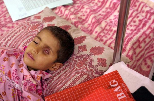 Four-year-old Alla Saleem, who suffers from a tumor in her eye, lies on her bed as she waits for medication at the Ghazwan Children's Hospital in the southern Iraqi town of Basra, about 60 kilometers (37 miles) from the border with Kuwait. Iraqi authorities claim that about 300 tons of bombs with depleted uranium were used by the allied forces during the Gulf War bombing campaign, and this caused the increase of cancer cases in the area.  According to Doctor Jawal Al-Ali, chief cancer consultant of the Basra teaching hospital and member of the Royal College of Physicians in London, these cases have multiplied by 12 since 1991. - Sputnik International
