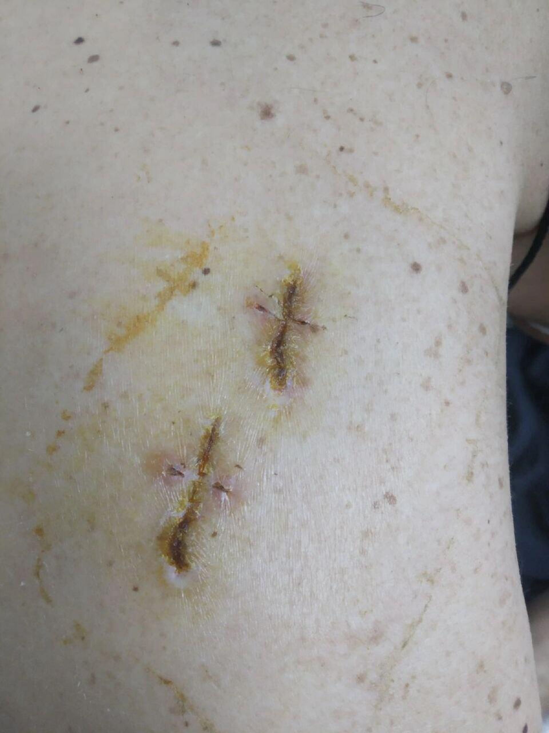 Signs of beatings and torture endured by Viktor, a serviceman in the Donetsk People's Republic (DPR) forces, when a prisoner of Ukraine's military and ultra-nationalists. - Sputnik International, 1920, 20.05.2023