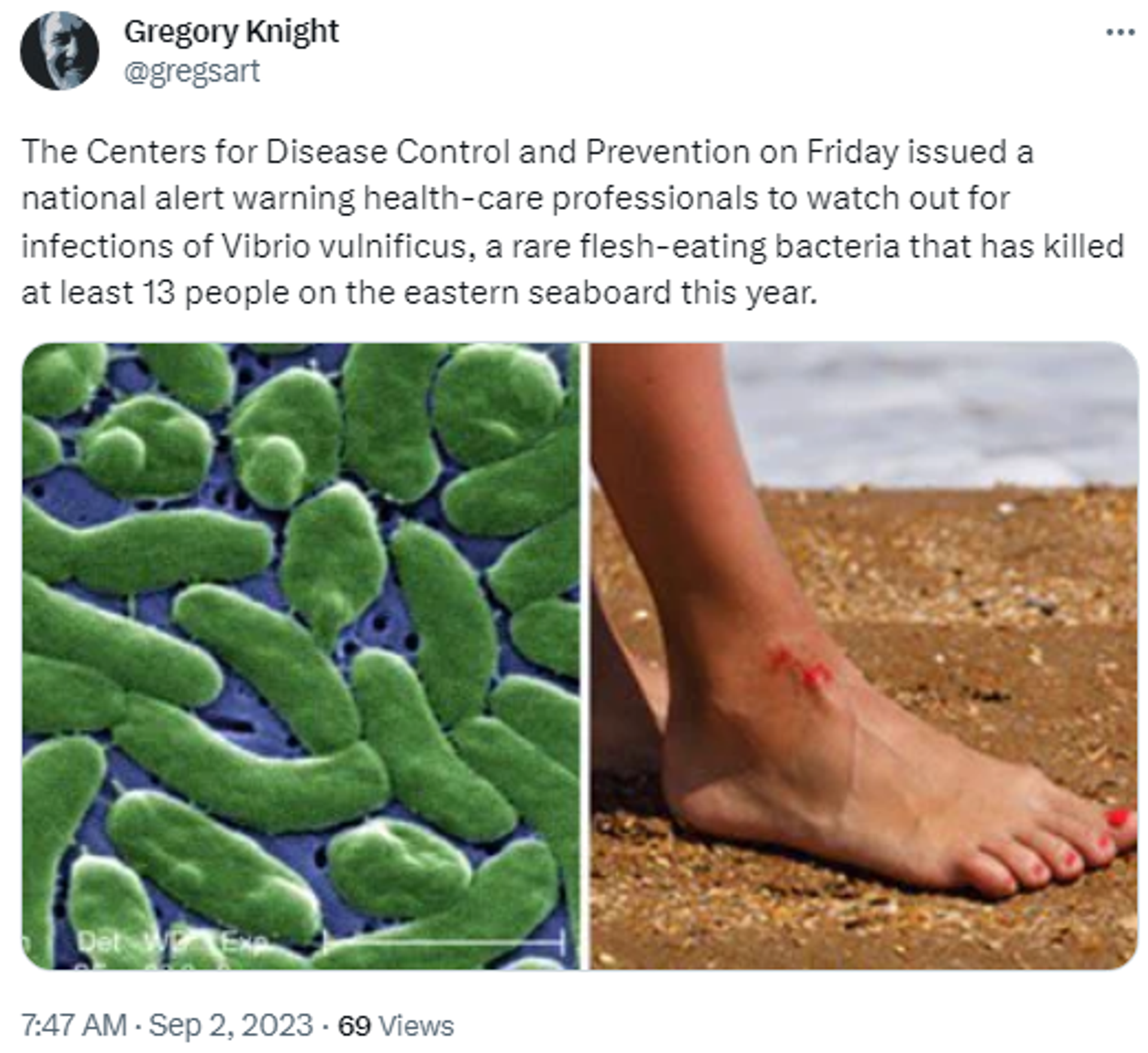 X Screenshot featuring images of flesh-eating Vibrio vulnificus bacteria amid cases discovered in US. X Screenshot featuring images of flesh-eating Vibrio vulnificus bacteria amid cases discovered in US. - Sputnik International, 1920, 02.09.2023