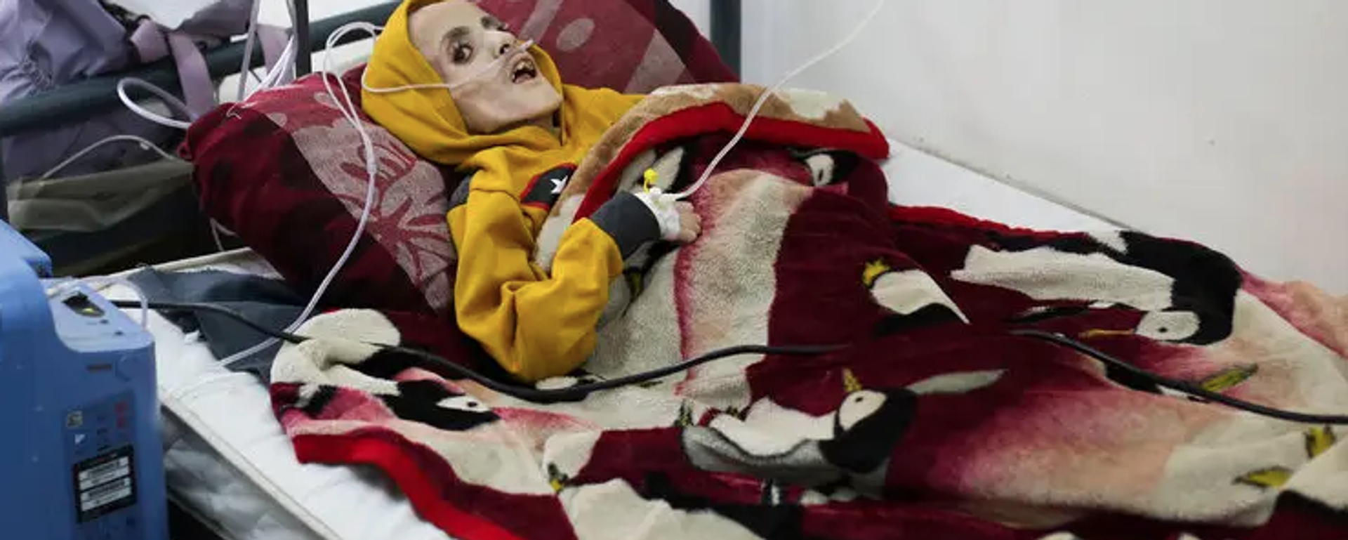 Yazan Kafarneh on his hospital bed in Rafah, southern Gaza, on Sunday. By Monday, he was dead. - Sputnik International, 1920, 10.03.2024