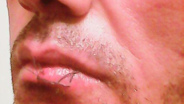 An asylum seeker is pictured with his lips sewn together in this handout picture provided by the refugee action coalition, taken inside the Manus Island detention centre in Papua New Guinea January 13, 2015. - Sputnik International