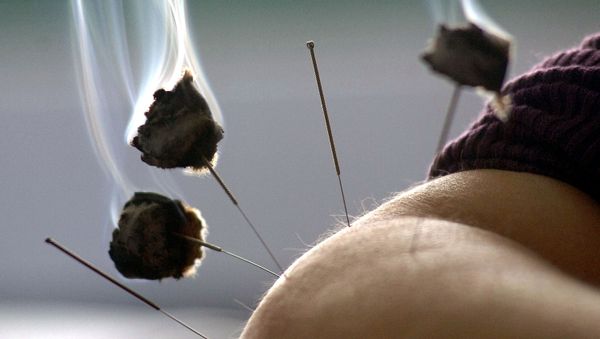 A patient undergoes an acupuncture fire treatment at the Anhui traditional Chinese medicine college No. 2 hospital, in Hefei, central China's Anhui province - Sputnik International