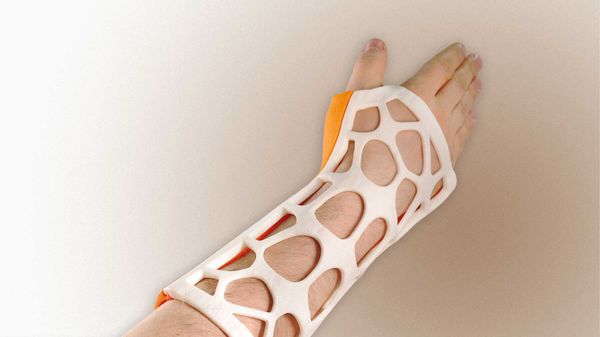 3D printed plastic casts and splints - Sputnik International