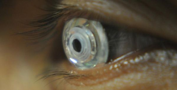 The latest telescopic contact lens - Sputnik International