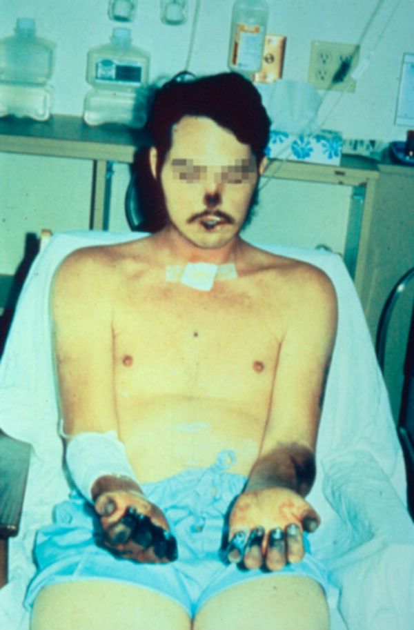 Acral necrosis of the nose, the lips, and the fingers and residual ecchymoses over both forearms in a patient recovering from bubonic plague that disseminated to the blood and the lungs. Acral necrosis of the nose, the lips, and the fingers and residual ecchymoses over both forearms in a patient recovering from bubonic plague that disseminated to the blood and the lungs. - Sputnik International