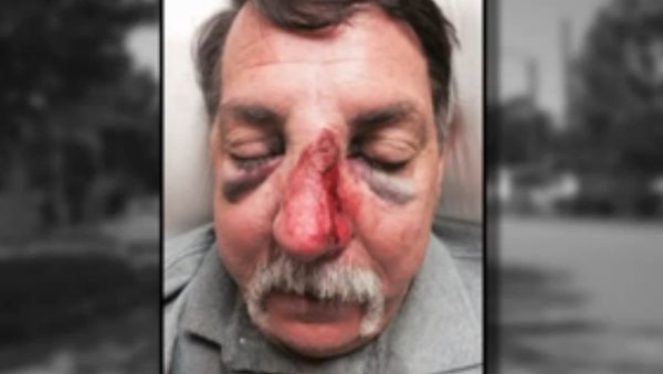 A Missouri man says he suffered serious injuries including a broken nose when an off-duty police officer assaulted him in an incident of road-rage. - Sputnik International