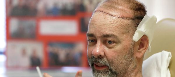 A Texas man has had the first successful skull-scalp transplant from a human donor at the same time as he received a double organ transplant, saving his life amid a perfect storm of ailments. A Texas man has had the first successful skull-scalp transplant from a human donor at the same time as he received a double organ transplant, saving his life amid a perfect storm of ailments. - Sputnik International