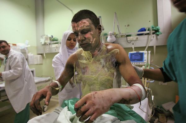 A Palestinian man is treated for burns in Jan. 2009. Human Rights Watch reported in March 2009 that Israel had used white phosphorous in the densely populated Gaza strip, in violation of international law. A Palestinian man is treated for burns in Jan. 2009. Human Rights Watch reported in March 2009 that Israel had used white phosphorous in the densely populated Gaza strip, in violation of international law. - Sputnik International