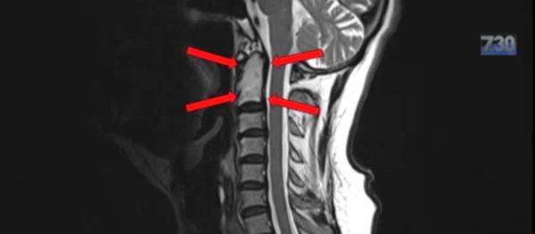 X-ray photograph of spinal cord tumor X-ray photograph of spinal cord tumor - Sputnik International