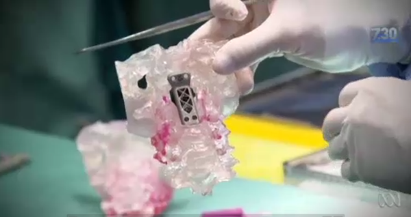 Customized 3D-printed cervical vertebrae - Sputnik International