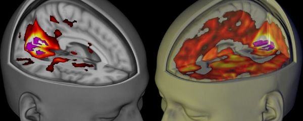 Handout shows the brains of subjects lying awake with their eyes closed, under a placebo and the drug LSD, when being examined using functional MRI. Handout shows the brains of subjects lying awake with their eyes closed, under a placebo and the drug LSD, when being examined using functional MRI. - Sputnik International