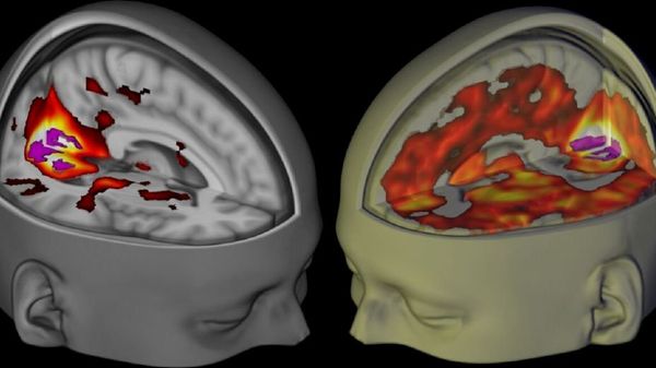 Handout shows the brains of subjects lying awake with their eyes closed, under a placebo and the drug LSD, when being examined using functional MRI. - Sputnik International