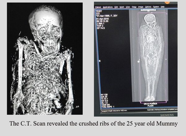 The C. T. scan of the Mummy - Sputnik International