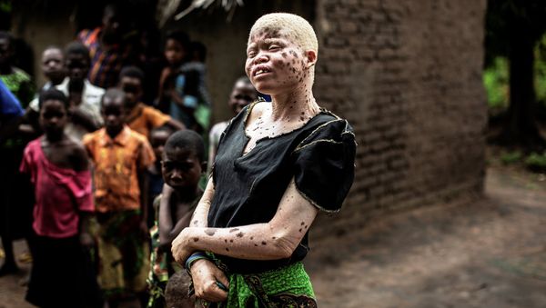 Mainasi Issa, a 23-year-old Malawian albino woman, stands outside her hut in the traditional authority area of Nkole, Machinga district, on April 17, 2015. - Sputnik International