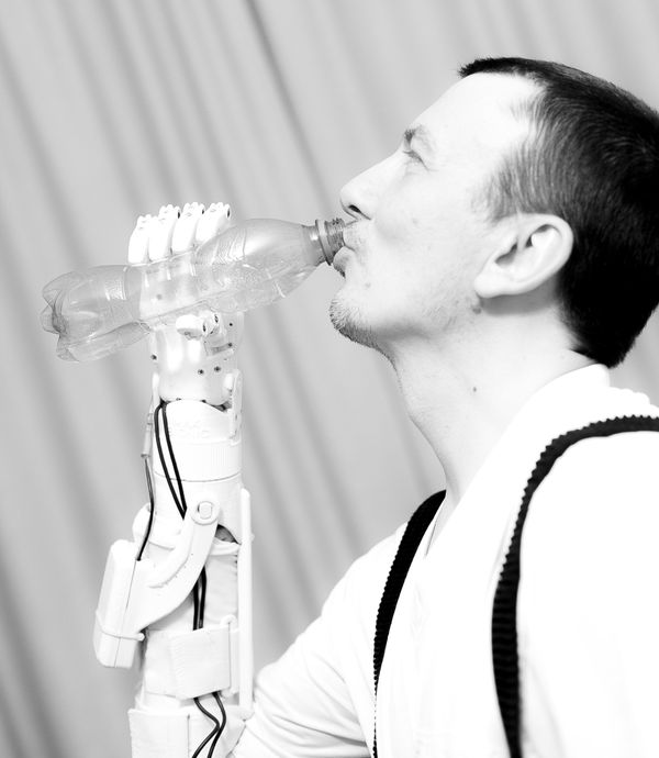 A patient with the MaxBionic prosthesis  - Sputnik International
