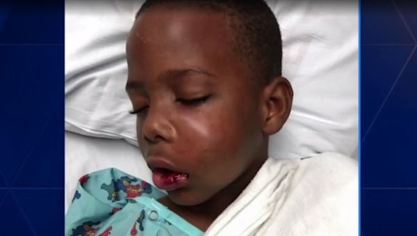 Trayvon Grayson in the hospital after a tutor at his school broke his jaw - Sputnik International