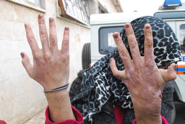 Woman in Aleppo shows her burnt hands Woman in Aleppo shows her burnt hands - Sputnik International
