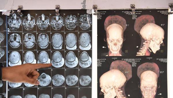 Indian doctor Ramanuj Kabra points to brain scans of Santlal Pal, 31, at the BYL Nair hospital in Mumbai on February 22, 2018 - Sputnik International