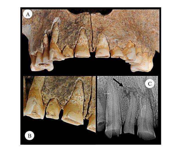 Buccal view of surface wear of the RI2 (A and B); type and orientation of wear is a clear  indication of the extra-masticatory use of the tooth, which shows a crown significantly reduced (if  not obliterated) in comparison to the left second incisor. (C) X-ray of the right upper second incisor  tooth, notice the periapical lesion located at the proximal end of the root, T US 380. The lighter col - oured bone around the margins of the exposed tooth roots RI2 is the result of post-mortem damage - Sputnik International