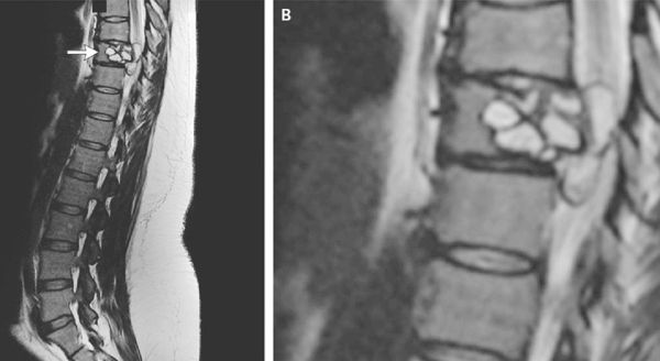 Above, the tapeworm cyst-caused lesion that caused a 35-year-old French woman to lose sensation and feel painful shocks in both her legs Above, the tapeworm cyst-caused lesion that caused a 35-year-old French woman to lose sensation and feel painful shocks in both her legs - Sputnik International