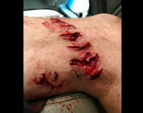 Texas man bitten by shark in early August contacts flesh-eating bacteria Texas man bitten by shark in early August contacts flesh-eating bacteria - Sputnik International