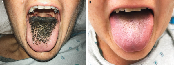 Missouri woman contracts Black Hairy Tongue after having a bad reaction to antibiotics. Image 'A' shows the discoloration observed by officials and image 'B' shows the patient's tongue after minocycline, the antibiotic the caused the condition, was stopped. Missouri woman contracts Black Hairy Tongue after having a bad reaction to antibiotics. Image 'A' shows the discoloration observed by officials and image 'B' shows the patient's tongue after minocycline, the antibiotic the caused the condition, was stopped. - Sputnik International
