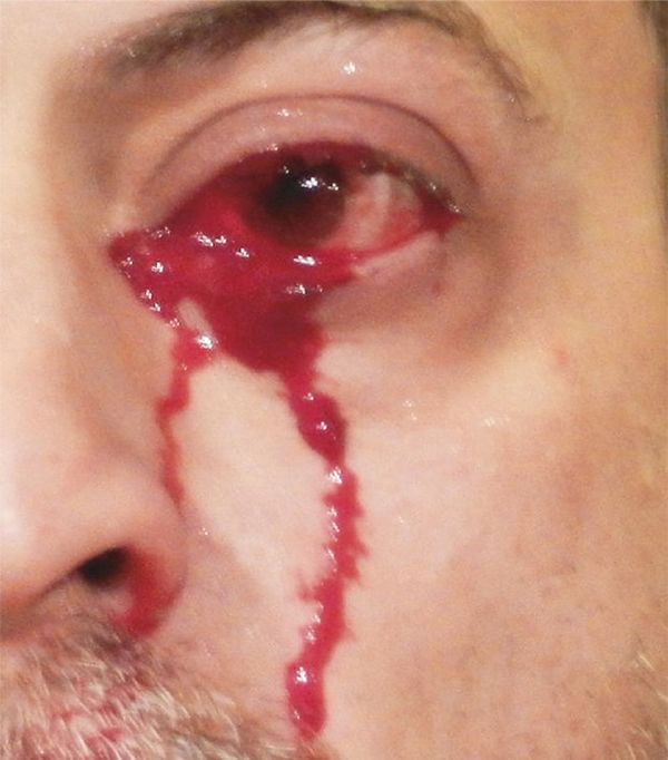 The man went to hospital after he started weeping blood The man went to hospital after he started weeping blood - Sputnik International