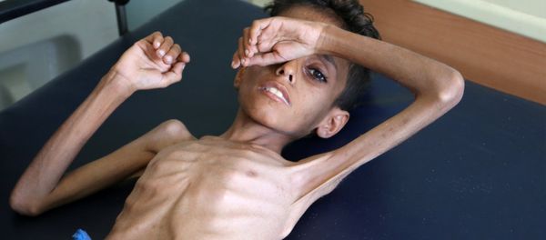 Yemeni boy Ghazi Ali bin Ali, 10, suffering from severe malnutrition lies on a bed at a hospital in Jabal Habashi on the outskirts of the city of Taiz, on October 30, 2018 Yemeni boy Ghazi Ali bin Ali, 10, suffering from severe malnutrition lies on a bed at a hospital in Jabal Habashi on the outskirts of the city of Taiz, on October 30, 2018 - Sputnik International