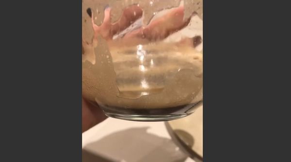 Kim Kardashian is treating her psoriasis - Sputnik International