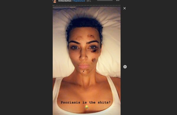 Kim Kardashian psoriasis - Sputnik International