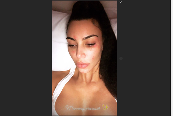 Kim Kardashian psoriasis - Sputnik International
