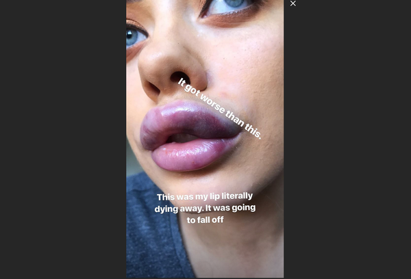 Cassidy Valentine's botched lip job - Sputnik International